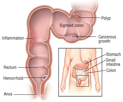 Sigmoidoscopy