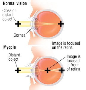 Nearsightedness (Myopia)