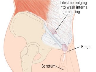 Inguinal Hernia