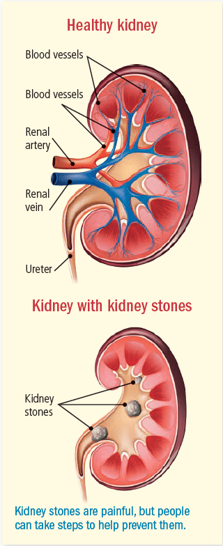 Kidney Stones Guide Causes Symptoms And Treatment Options