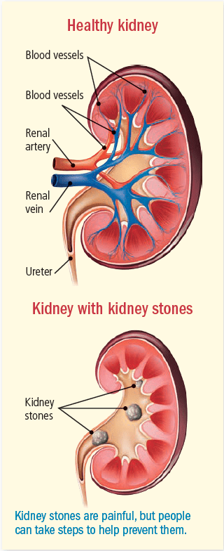 calcium stones deep in throat