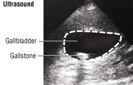 Gallstones