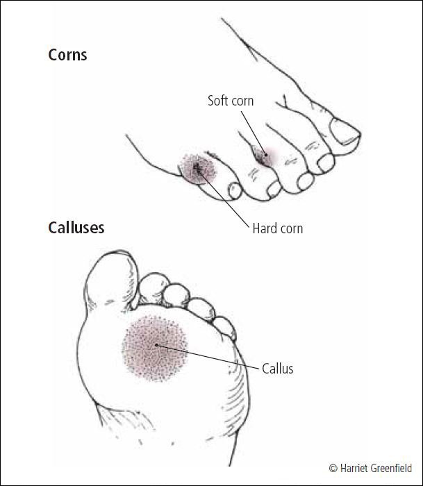 Corns and calluses