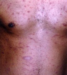 Pityriasis Rosea