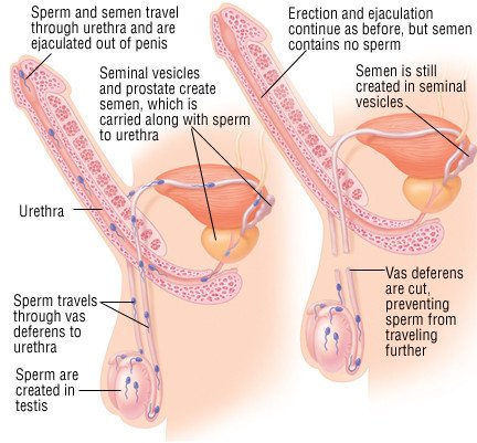 Vasectomy