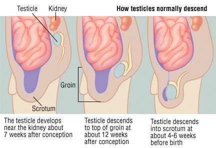 Undescended Testicle (Cryptorchidism)