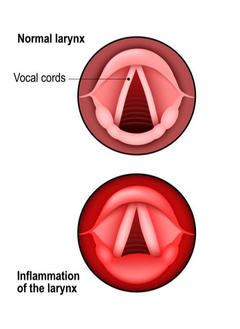 Croup