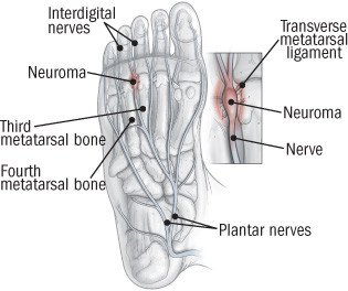 Morton's neuroma