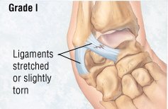 Ankle strain