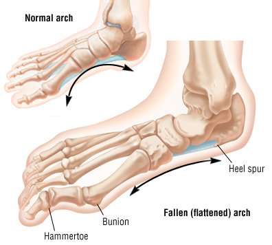 What kind of surgery is available for flat feet?