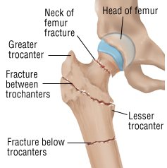 Hip Fracture