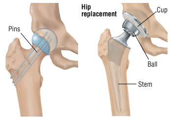 hip fracture treatment ball patient socket head metal symptoms trochanters between