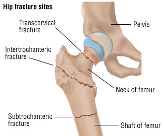 What causes bumps on the femur bone?