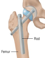 What causes bumps on the femur bone?