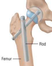 Broken femur rod pictures