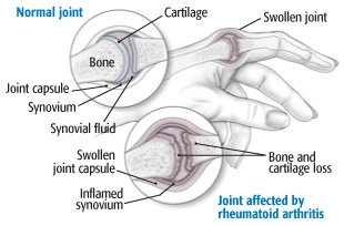 Rheumatoid arthritis