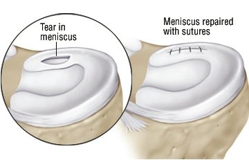 Torn Meniscus Guide: Causes, Symptoms and Treatment Options