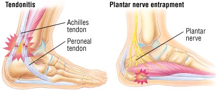 What are some causes of foot pain in the arch area?