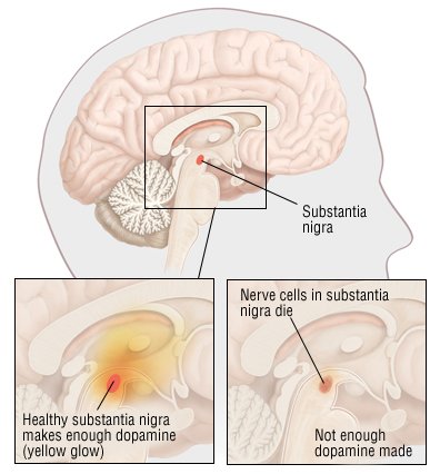 What are the early symptoms of Parkinson's disease?