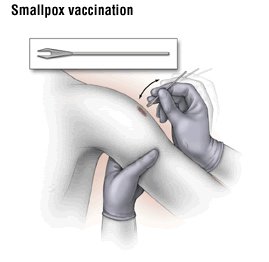 Smallpox guide signs symptoms treatment and prevention