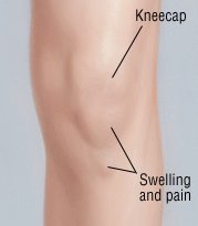 Osgood-Schlatter Disease Guide: Causes, Symptoms and Treatment Options