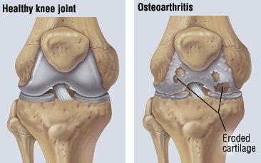 osteoartroza bolii de genunchi