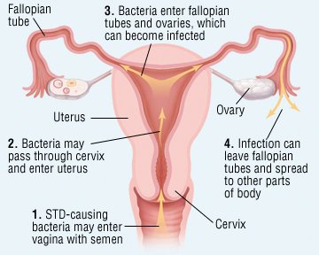Genital Herpes - Symptoms, Diagnosis, Treatment of Genital ...