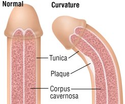 Dương vật bị cong khi cương cứng