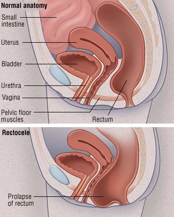 Pressure In Vagina 102