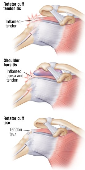 Shoulder Injuries and Disorders