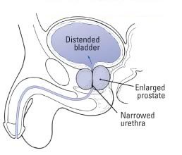 benign prostate hyperplasia mri