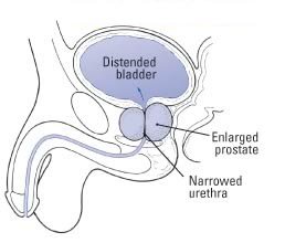 Jóindulatú prosztata megnagyobbodás (Benignus prostata hyperplasia: BPH) (x)