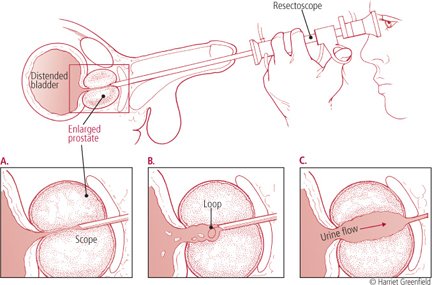 Prosztatagyulladás (prostatitis)