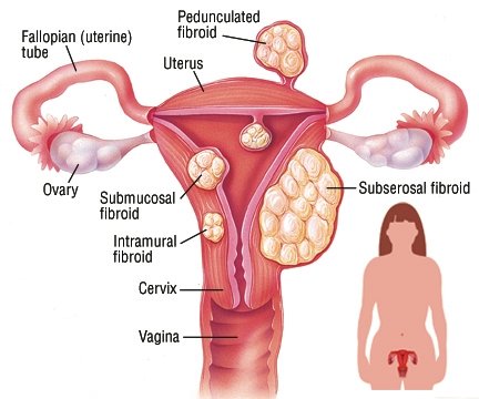 Prosztata szövet fibroidok