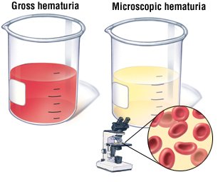 Is bloody urine a symptom of bladder cancer?