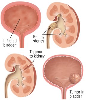 Is bloody urine a symptom of bladder cancer?