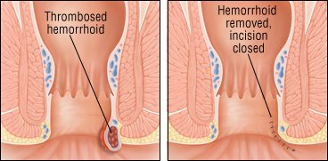 anal on Painful lump