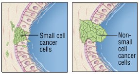 What are the key differences between nonsmall-cell and small-cell cancer?