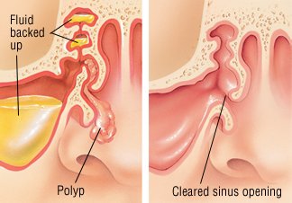 Nasal polyps steroid treatment side effects