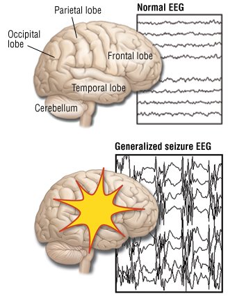Absence Seizures (Petit Mal Seizures) Guide: Causes, Symptoms and ...