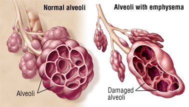 Emphysema is a respiratory disease. In this condition, millions of the lungs' tiny air sacs (alveoli) stretch out of shape or rupture.