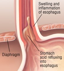 Acid reflux cause throat to swell