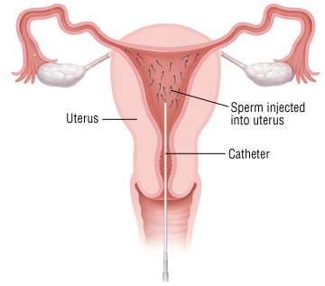 travelling uterus