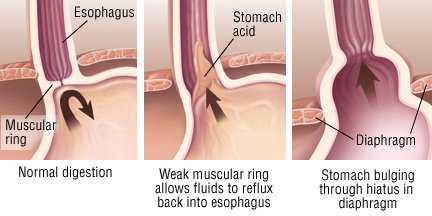 What are the symptoms of GERD?