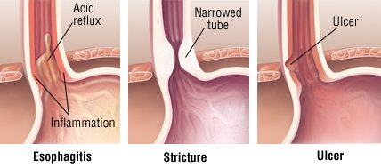 What are the symptoms of GERD?