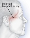 Giant cell arteritis (temporal arteritis)