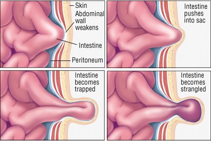 Estrangulamiento hernia