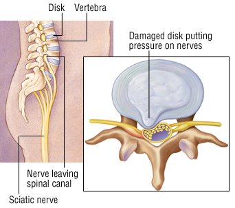 Epidural steroid injection for slip disc