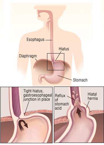 What can cause trapped gas in the esophagus and chest pain?