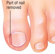 Ingrown Toenail Guide Causes Symptoms And Treatment Options Phenol Will Prevent That Area Of Your Cuticle From Producing New Nail So Toenail Be Narrower Than It Was Previously